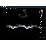 Folyamatos hullámú Doppler kép - MySono U6